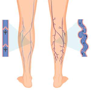 Varicose Veins