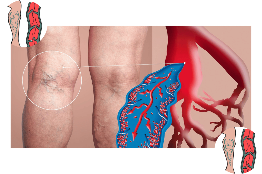 Deep vein thrombosis