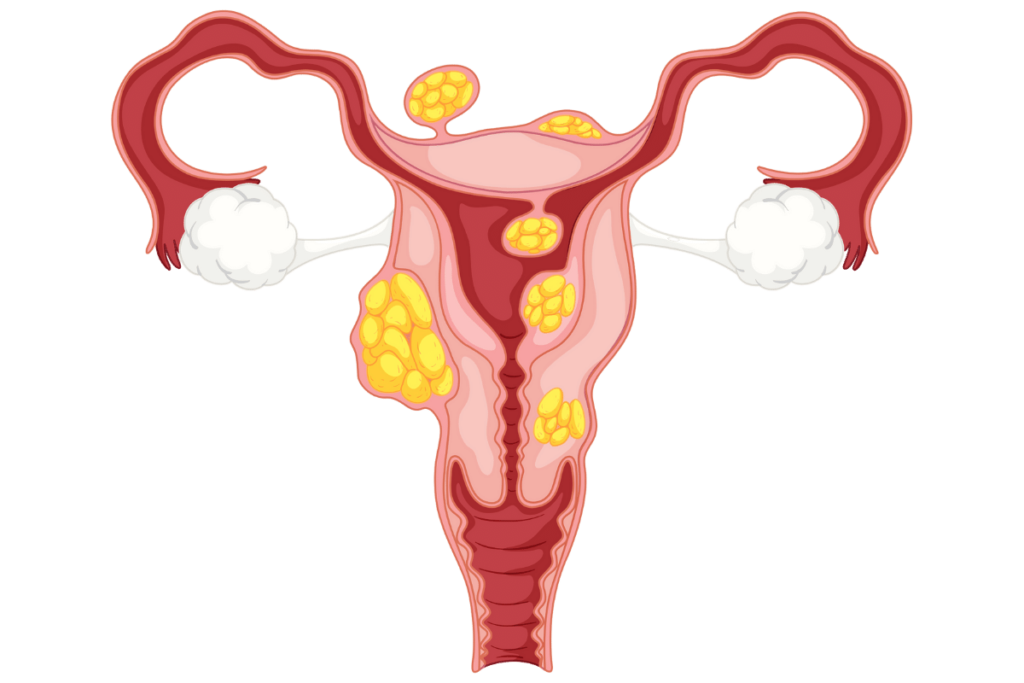 Uterine Fibroids