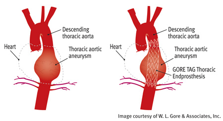 cs-thoracic-aortic-aneurysm-repair