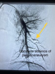 Pseudoaneurysm Embolization