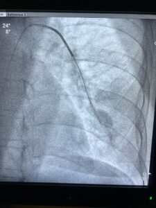 Pseudoaneurysm Embolization