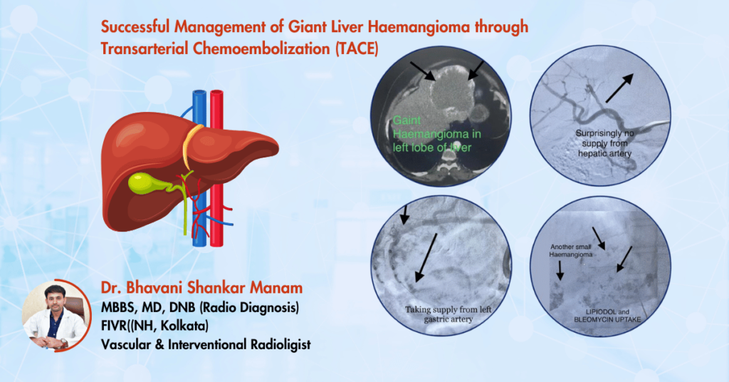 Giant liver haemangiomas