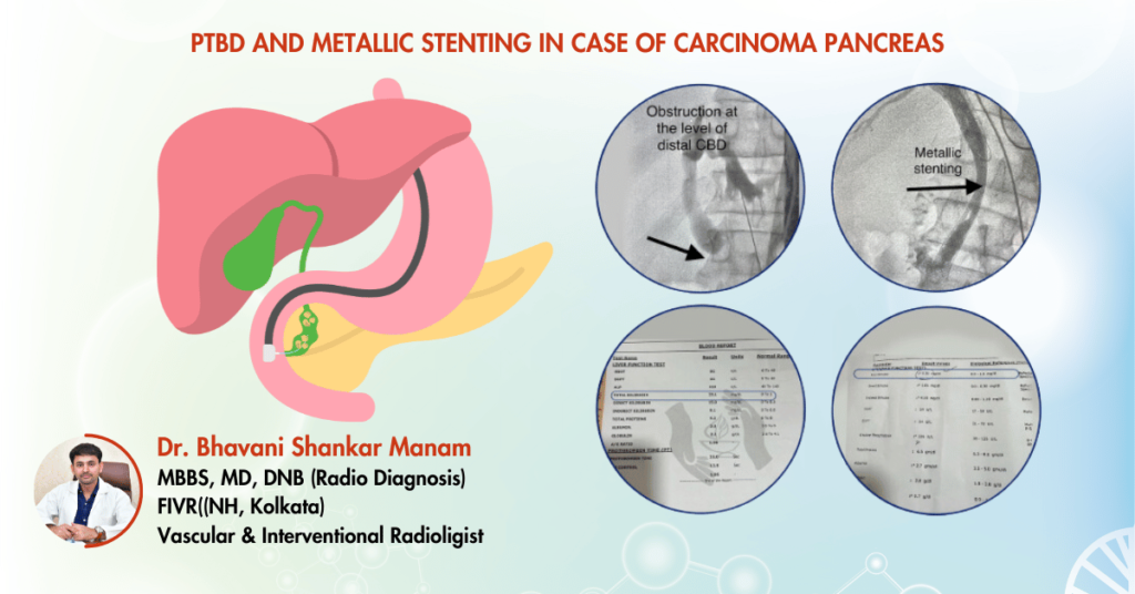 PTBD AND METALLIC STENTING IN CASE OF CARCINOMA PANCREAS