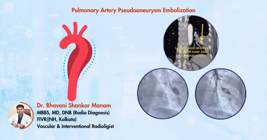 pulmonary artery pseudoaneurysm