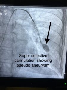 Pseudoaneurysm Embolization