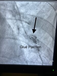 Pseudoaneurysm Embolization