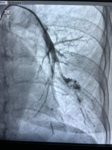 Pseudoaneurysm Embolization