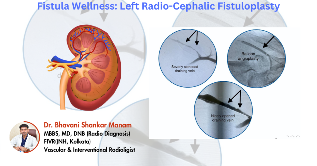 fistula-chronic kidney disease
