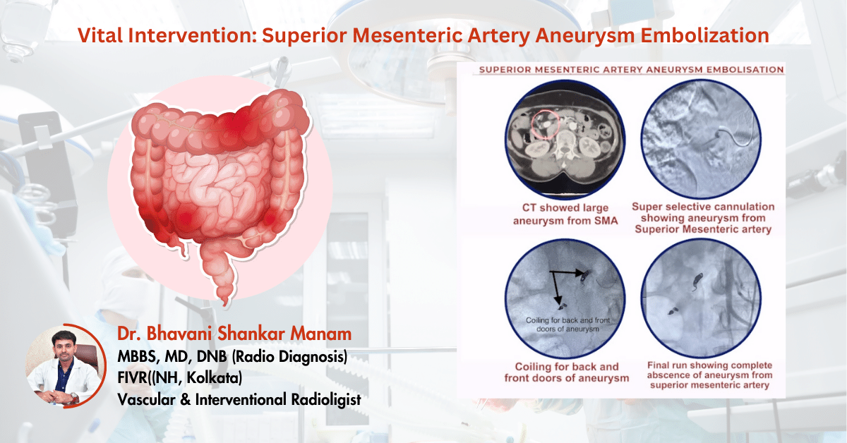 Superior Mesenteric Artery Aneurysm Embolization A Life Saving Intervention 3929