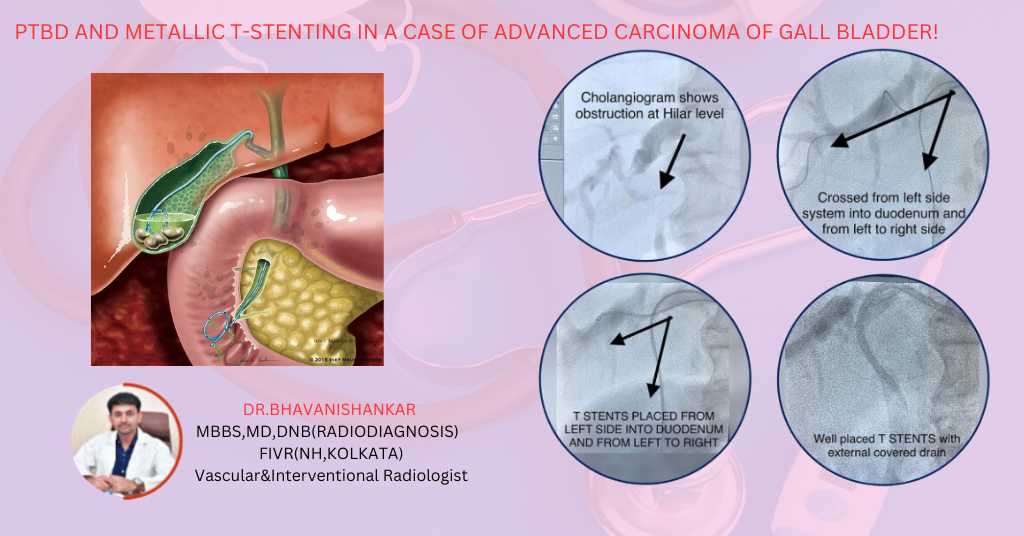 PTBD and Metallic T- stenting