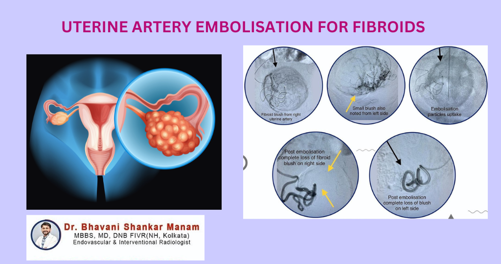 UTERINE ARTERY EMBOLISATION FOR FIBROIDS