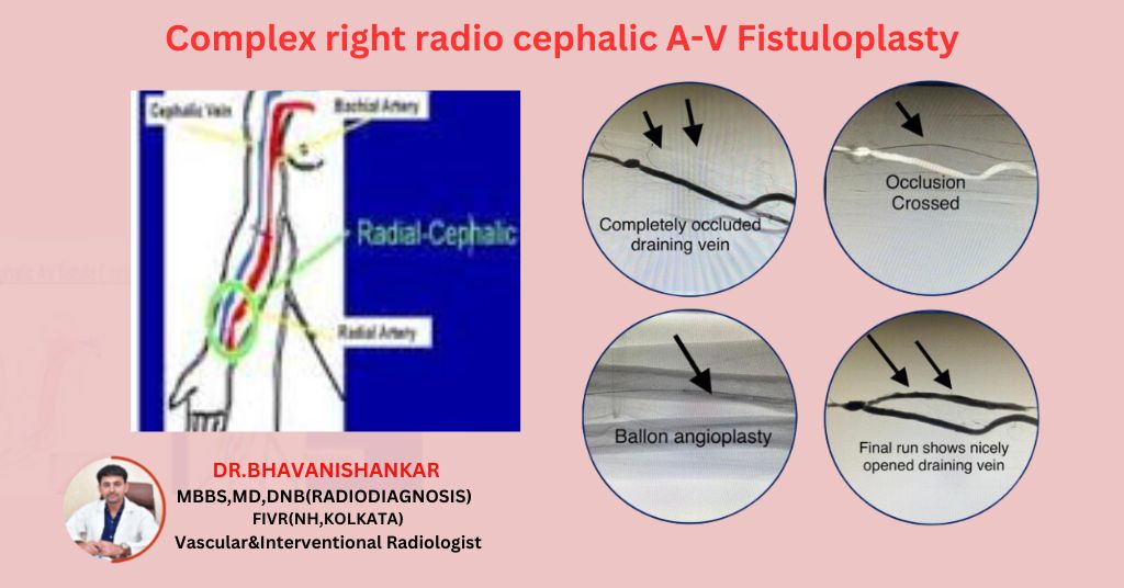 A-V Fistuloplasty