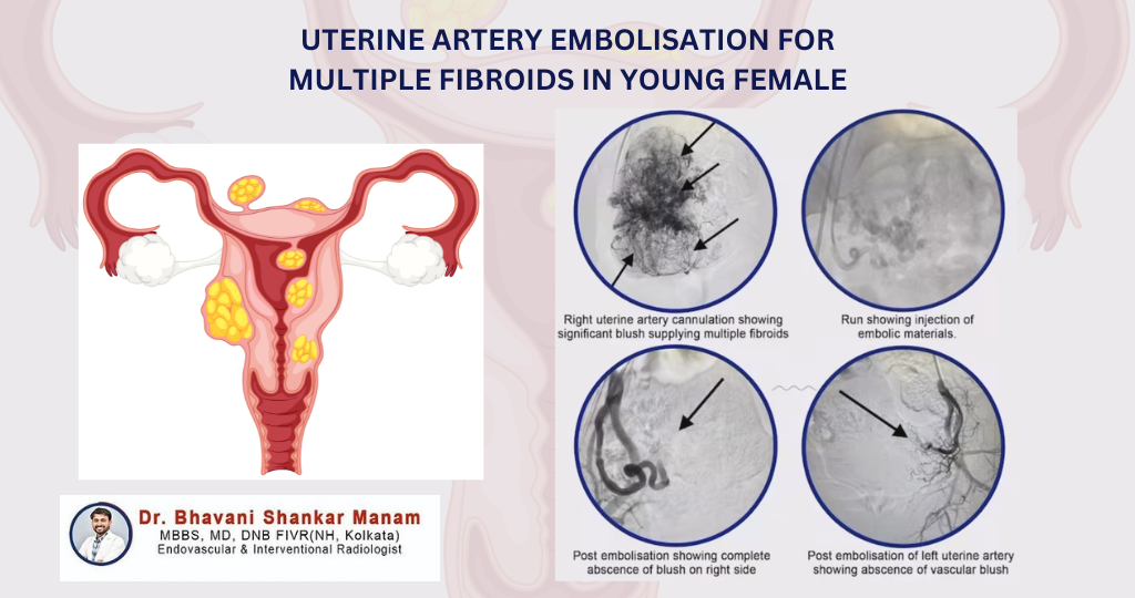 Fibroid Treatment for Young Women: Uterine Artery Embolization