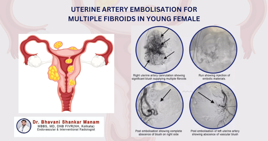 Uterine Artery Embolization Uterine Fibroid Embolization KCJOR Uterine Artery Embolization Uterine Fibroid Embolization KCJOR