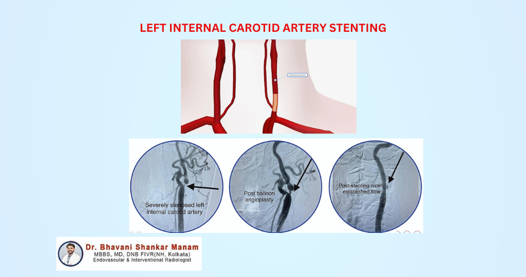 LEFT INTERNAL CAROTID ARTERY STENTING