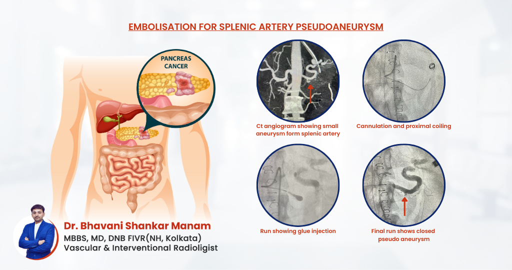 Successful Emergency Embolization for Splenic Artery Pseudoaneurysm in a Patient with Pancreatitis