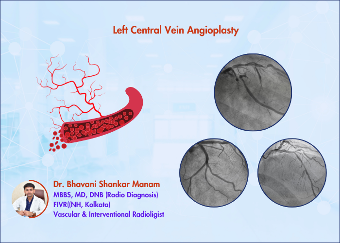 Left Central Vein Angioplasty