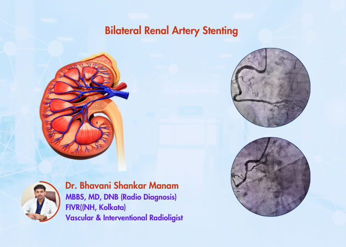 Bilateral Renal Artery Stenting