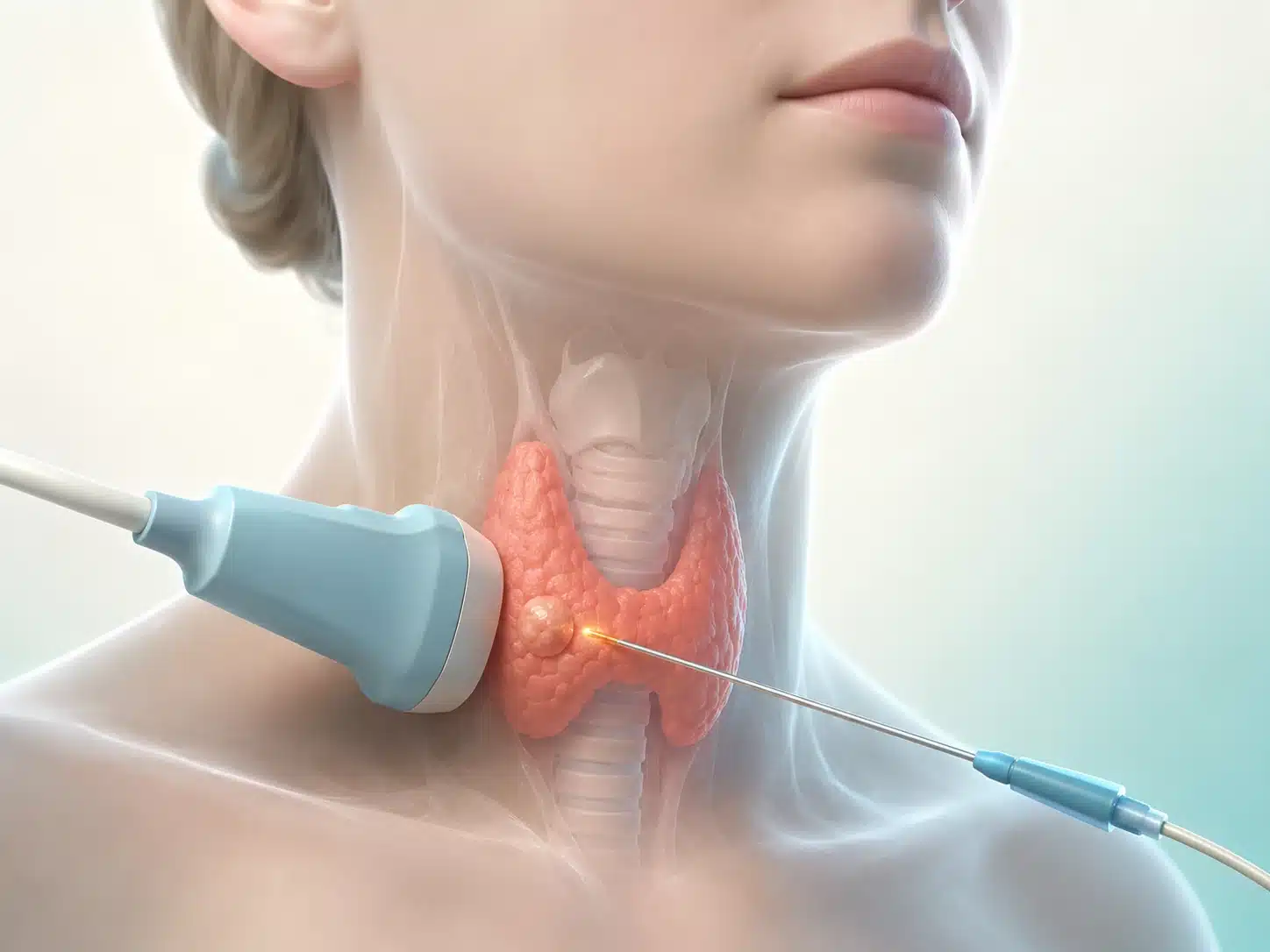 Thyroid Nodule Ablation